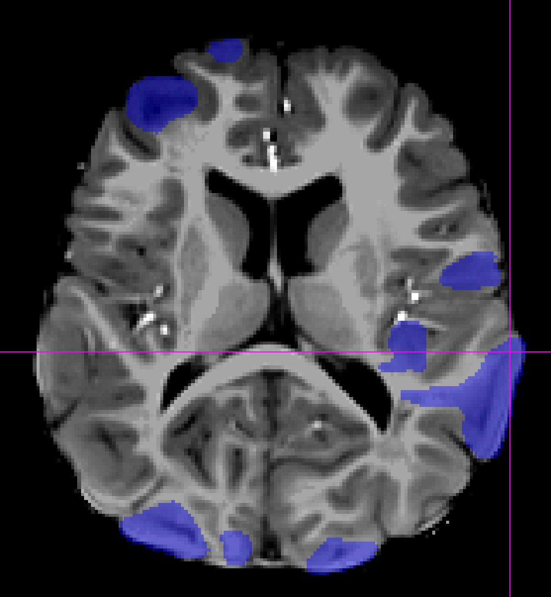 MRI of brain with TSC markers